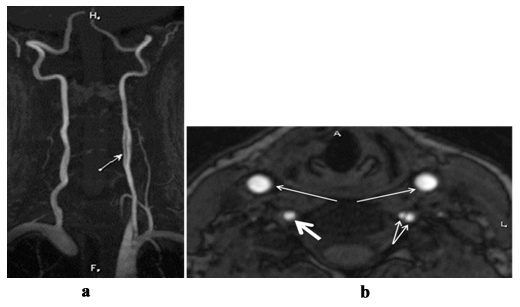 Spontaneous Cervical Arterial Dissection Several Aspects Of Magnetic Resonance Imaging 9899